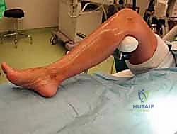 خطوات الجراحة الدقيقة