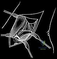 الكشف عن الأربطة الممزقة
