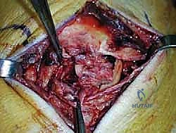 صورة طبية: إعادة بناء أربطة الكاحل الإنسية ورباط الدالية: استعادة الاستقرار والحركة في صنعاء مع الأستاذ الدكتور محمد هطيف