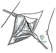 تحديد مسار الوتر والرباط