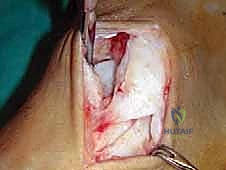 إعداد الرقعة الوترية