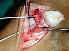 استخدام الخيوط الجراحية القوية