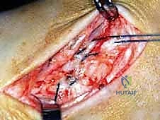 صورة طبية: إعادة بناء أربطة الكاحل الإنسية ورباط الدالية: استعادة الاستقرار والحركة في صنعاء مع الأستاذ الدكتور محمد هطيف