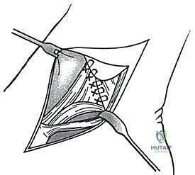 تشريح الكاحل الإنسي ورباط الدالية