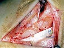 صورة طبية: إعادة بناء أربطة الكاحل الإنسية ورباط الدالية: استعادة الاستقرار والحركة في صنعاء مع الأستاذ الدكتور محمد هطيف