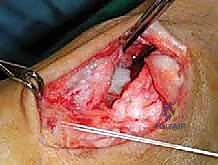 صورة طبية: إعادة بناء أربطة الكاحل الإنسية ورباط الدالية: استعادة الاستقرار والحركة في صنعاء مع الأستاذ الدكتور محمد هطيف