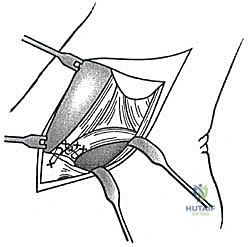 صورة طبية: إعادة بناء أربطة الكاحل الإنسية ورباط الدالية: استعادة الاستقرار والحركة في صنعاء مع الأستاذ الدكتور محمد هطيف