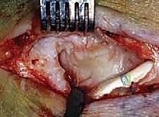 تثبيت الأربطة بالخطاطيف العظمية