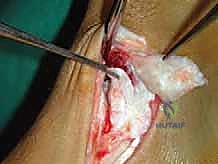 صورة طبية: إعادة بناء أربطة الكاحل الإنسية ورباط الدالية: استعادة الاستقرار والحركة في صنعاء مع الأستاذ الدكتور محمد هطيف