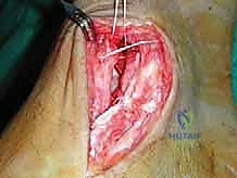 صورة طبية: إعادة بناء أربطة الكاحل الإنسية ورباط الدالية: استعادة الاستقرار والحركة في صنعاء مع الأستاذ الدكتور محمد هطيف