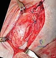 صورة طبية: إعادة بناء أربطة الكاحل الإنسية ورباط الدالية: استعادة الاستقرار والحركة في صنعاء مع الأستاذ الدكتور محمد هطيف