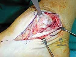 صورة طبية: إعادة بناء أربطة الكاحل الإنسية ورباط الدالية: استعادة الاستقرار والحركة في صنعاء مع الأستاذ الدكتور محمد هطيف