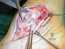 تقييم الشد والتوتر في الرباط