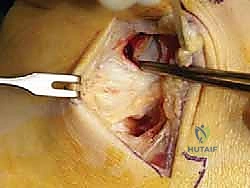 صورة توضيحية لـ إعادة بناء أربطة الكاحل الإنسية ورباط الدالية: استعادة الاستقرار والحركة في صنعاء مع الأستاذ الدكتور محمد هطيف