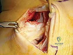 صورة توضيحية لـ إعادة بناء أربطة الكاحل الإنسية ورباط الدالية: استعادة الاستقرار والحركة في صنعاء مع الأستاذ الدكتور محمد هطيف