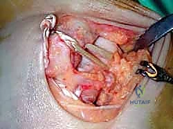 صورة توضيحية لـ إعادة بناء أربطة الكاحل الإنسية ورباط الدالية: استعادة الاستقرار والحركة في صنعاء مع الأستاذ الدكتور محمد هطيف