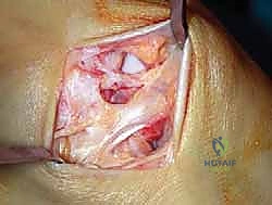 إعادة بناء أربطة الكاحل الإنسية ورباط الدالية: استعادة الاستقرار والحركة في صنعاء مع الأستاذ الدكتور محمد هطيف