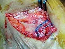 صورة طبية: إعادة بناء أربطة الكاحل الإنسية ورباط الدالية: استعادة الاستقرار والحركة في صنعاء مع الأستاذ الدكتور محمد هطيف