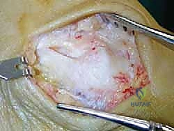 صورة طبية: إعادة بناء أربطة الكاحل الإنسية ورباط الدالية: استعادة الاستقرار والحركة في صنعاء مع الأستاذ الدكتور محمد هطيف