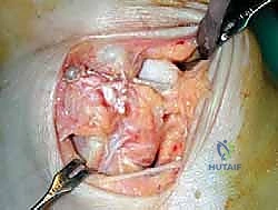 صورة طبية: إعادة بناء أربطة الكاحل الإنسية ورباط الدالية: استعادة الاستقرار والحركة في صنعاء مع الأستاذ الدكتور محمد هطيف