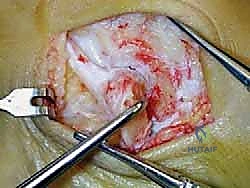 صورة طبية: إعادة بناء أربطة الكاحل الإنسية ورباط الدالية: استعادة الاستقرار والحركة في صنعاء مع الأستاذ الدكتور محمد هطيف