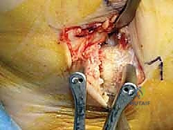 صورة طبية: إعادة بناء أربطة الكاحل الإنسية ورباط الدالية: استعادة الاستقرار والحركة في صنعاء مع الأستاذ الدكتور محمد هطيف