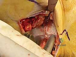 صورة طبية: إعادة بناء أربطة الكاحل الإنسية ورباط الدالية: استعادة الاستقرار والحركة في صنعاء مع الأستاذ الدكتور محمد هطيف