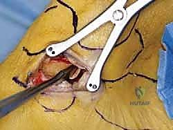 صورة طبية: إعادة بناء أربطة الكاحل الإنسية ورباط الدالية: استعادة الاستقرار والحركة في صنعاء مع الأستاذ الدكتور محمد هطيف
