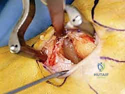 تثبيت الرقعة في الكعب الإنسي