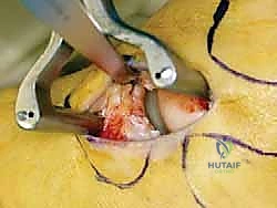 إصلاح الأربطة خطوة بخطوة