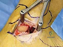 صورة طبية: إعادة بناء أربطة الكاحل الإنسية ورباط الدالية: استعادة الاستقرار والحركة في صنعاء مع الأستاذ الدكتور محمد هطيف