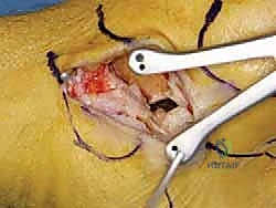 استكمال الخياطة الجراحية