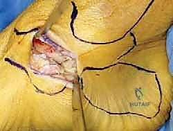 صورة مكبرة للعملية الجراحية