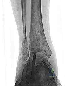 صورة طبية: إعادة بناء أربطة الكاحل الإنسية ورباط الدالية: استعادة الاستقرار والحركة في صنعاء مع الأستاذ الدكتور محمد هطيف