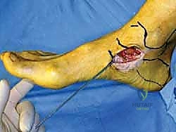 الخياطة النهائية للرقعة