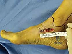 صورة طبية: إعادة بناء أربطة الكاحل الإنسية ورباط الدالية: استعادة الاستقرار والحركة في صنعاء مع الأستاذ الدكتور محمد هطيف