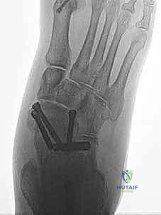 صورة طبية: إعادة بناء أربطة الكاحل الإنسية ورباط الدالية: استعادة الاستقرار والحركة في صنعاء مع الأستاذ الدكتور محمد هطيف