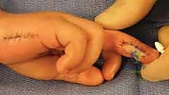 العلاج التحفظي وتغيير الضمادات