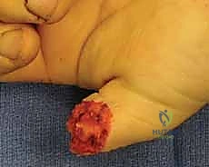 سديلة V-Y المتقدمة