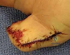 إعادة بناء طرف الإصبع: استعادة الحساسية والوظيفة مع الأستاذ الدكتور محمد هطيف في صنعاء