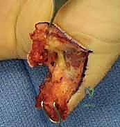 تشريح طرف الإصبع والأعصاب