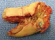 صورة توضيحية لـ إعادة بناء طرف الإصبع: استعادة الحساسية والوظيفة مع الأستاذ الدكتور محمد هطيف في صنعاء