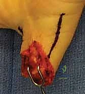 سديلة الإصبع المتقاطع