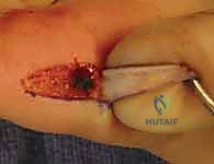 تصنيفات إصابات أطراف الأصابع