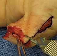 التقييم السريري لإصابة الإصبع