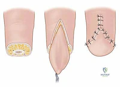 إصابات العمل السحقية