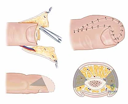 تفاصيل الأوعية الدموية في اليد