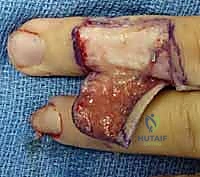 صورة طبية: إعادة بناء طرف الإصبع: استعادة الحساسية والوظيفة مع الأستاذ الدكتور محمد هطيف في صنعاء