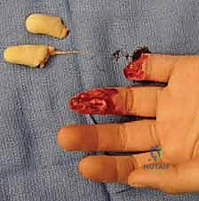 صورة طبية: إعادة بناء طرف الإصبع: استعادة الحساسية والوظيفة مع الأستاذ الدكتور محمد هطيف في صنعاء