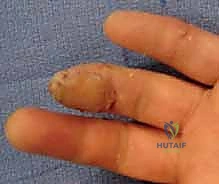 صورة طبية: إعادة بناء طرف الإصبع: استعادة الحساسية والوظيفة مع الأستاذ الدكتور محمد هطيف في صنعاء